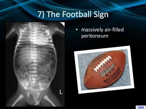 Signs Of Pneumoperitoneum On Plain Film