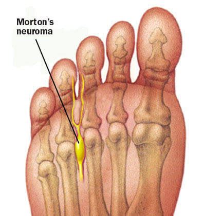 Mortons Neuroma Corrigan Podiatry