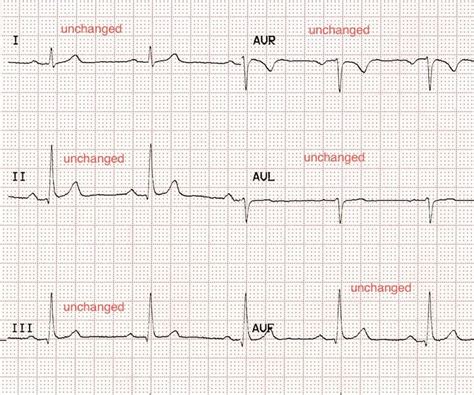 Ecg Limb Lead Reversal Litfl Ecg Library Diagnosis