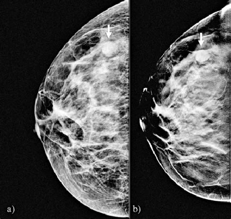 Mammographic Appearance Of A Fibroadenoma Arrows On D A And D