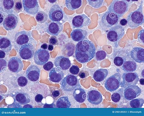 Multiple Myeloma in Bone Marrow Stock Image - Image of infiltration ...