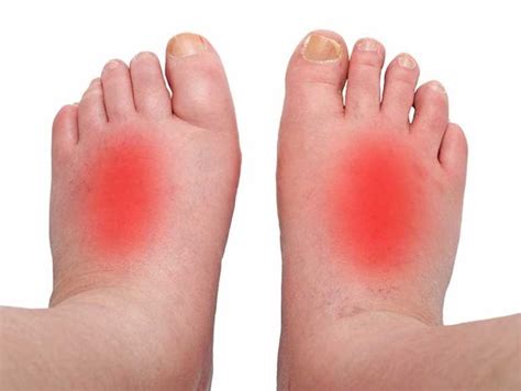 Foot Cellulitis Royal Podiatry