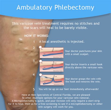 Varicose Vein Removal Ocala Ambulatory Phlebectomy