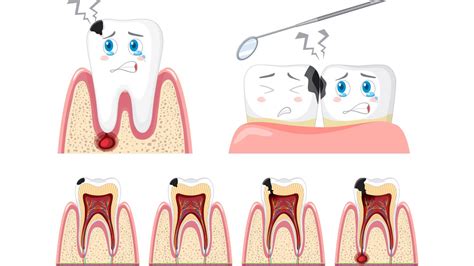 Understanding The Types Of Dental Caries Smile 360 Dental Clinic