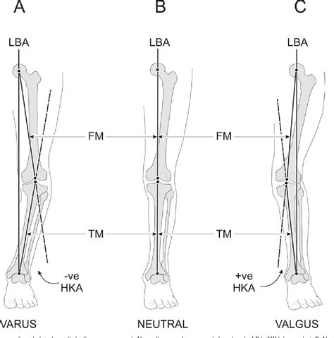 Figure 1 From Frontal Plane Knee Alignment A Call For Standardized