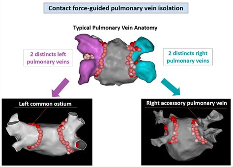 Posterior View Of The Left Atrium In The 3 Types Of Pulmonary Vein Download Scientific Diagram