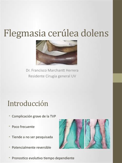 Flegmasia Cerúlea Dolens Pdf Especialidades Medicas Medicina Clinica