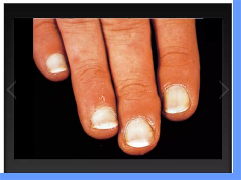 Nail Disorder Dr Aisha Almoosa Ppt