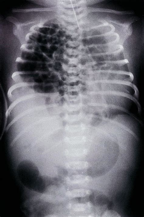 Congenital Diaphragmatic Hernia Types