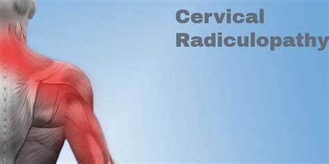 Cervical Radiculopathy: Symptoms & Treatments - Legacy Spine ...