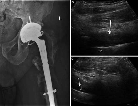 Ultrasound of the Hip | Musculoskeletal Key