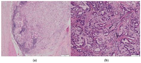 Biomedicines Free Full Text Isolated Gastric Metastases Of