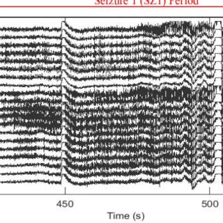 Waveforms Of Event SZ1 From Pre Ictal Ictal And Post Ictal Periods