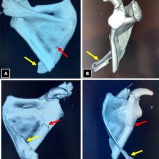 3D reconstruction of the scapula. In the posterior view (A), the ...