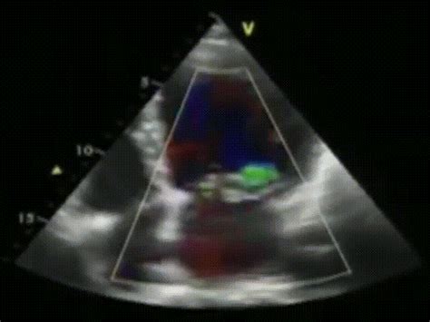 Fa Regurgitação Mitral E Formação De Trombo Atrial