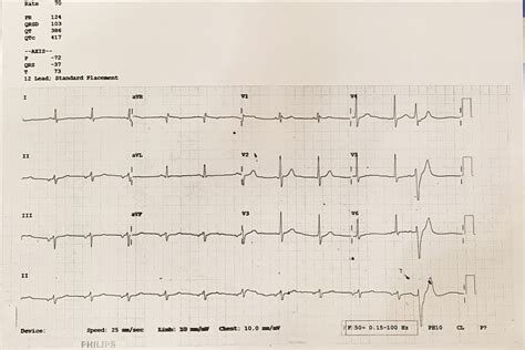 What’s with the inverted P waves? – Dr.Aarthi2410