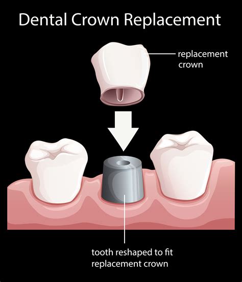 A dental crown replacement 295135 Vector Art at Vecteezy