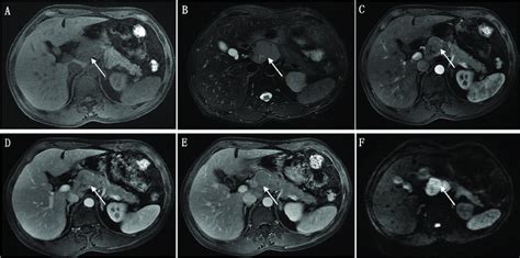 A 54 Year Old Male Patient With Pathologically Proven Pancreatic