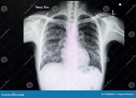 Chest X Ray Showing Pneumonia