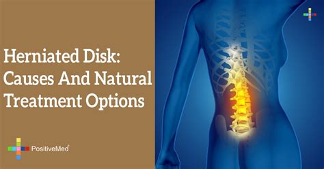 Herniated Disk Causes And Natural Treatment Options Positivemed