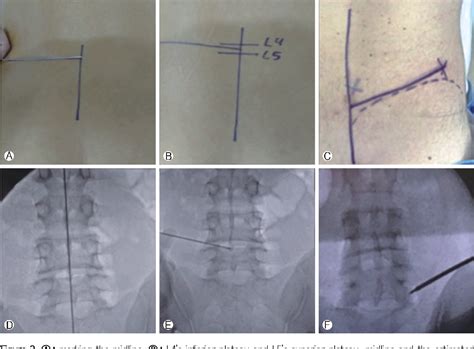 Figure 2 From Transforaminal Percutaneous Endoscopic Lumbar Discectomy