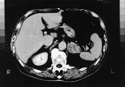 Figure 1 From Adrenalectomy For Solitary Adrenal Metastasis From