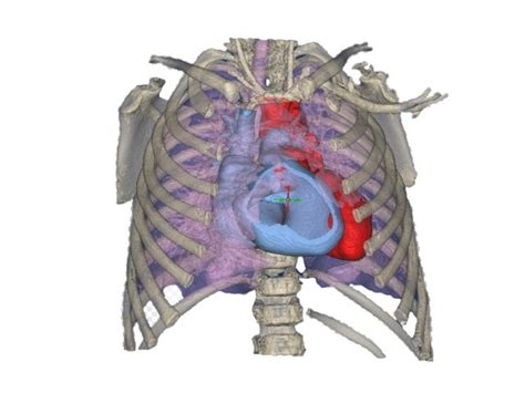 Pulmonary Artery Stenosis after ASO | 3D Life