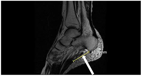 Mri Of A Torn Tendon Foot