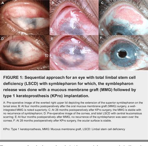 PDF Management Of Symblepharon Prior To Keratoprosthesis In Chronic