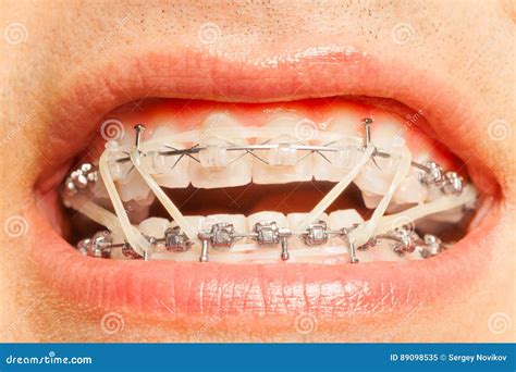 Dental Braces With Orthodontic Correction Rings On Stock Image Image