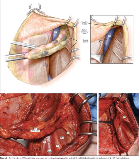 Central Neck Dissection Technique