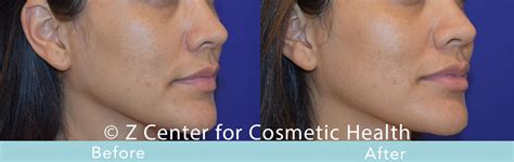 Fillers - Cheeks - Zcosmetic Health