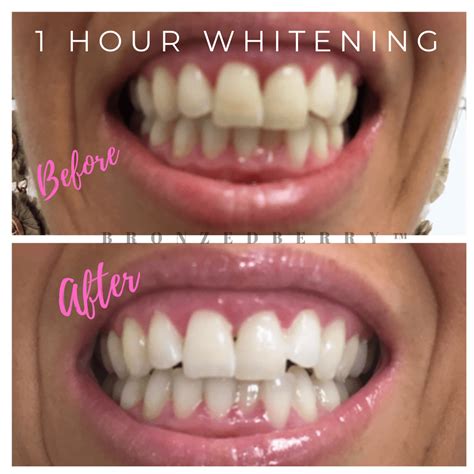 Smile Direct Club Whitening Reviews Reddit Jed Kraft