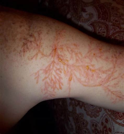 Lichtenberg Figures: The Fractal Patterns of Lightning Strike Scars ...