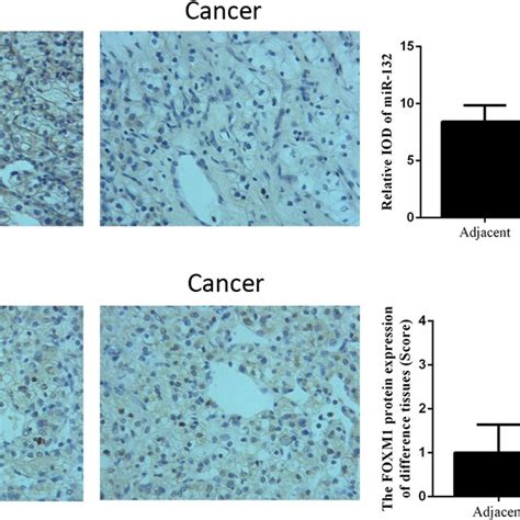 The Expression Levels Of Mirna And Foxm In Normal Tissues And Rcc