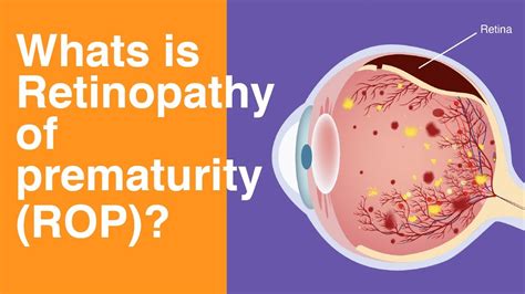 What Is Retinopathy Of Prematurity Rop Retinopathyofprematurity Youtube