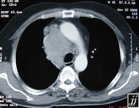 Mediastinal mass – Radiopaedia