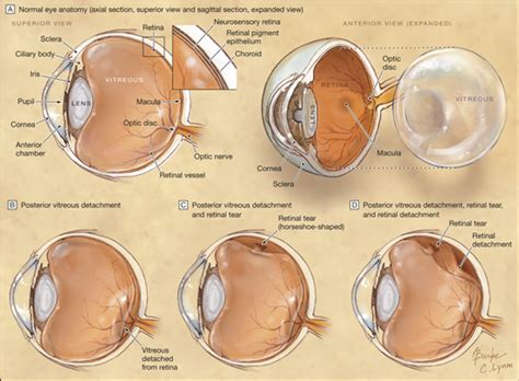 Acute Onset Floaters And Flashes Is This Patient At Risk For Retinal