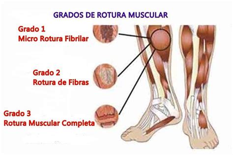 Qué es un desgarro muscular y cómo evitarlo Adictos al Gym