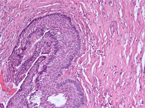 Pathology Outlines Adamantinomatous Craniopharyngioma