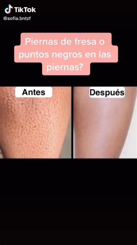 Quitar Puntos Negros De Las Piernas Video En 2020 Remedios De