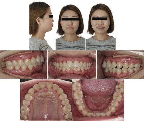 Pretreatment Facial And Intraoral Photographs Download Scientific