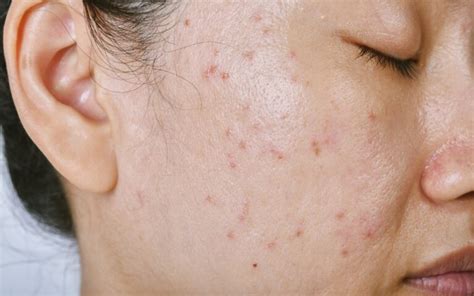 Understanding Acne Papules Causes Treatment And Prevention