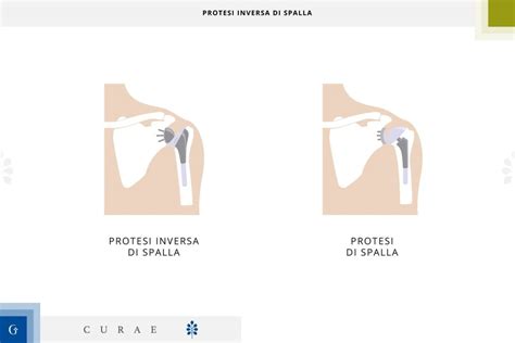 Protesi Inversa Spalla Quando Usarla Intervento Durata E Riabilitazione