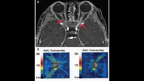 Optic Nerve Lesions - The Neurology Hub