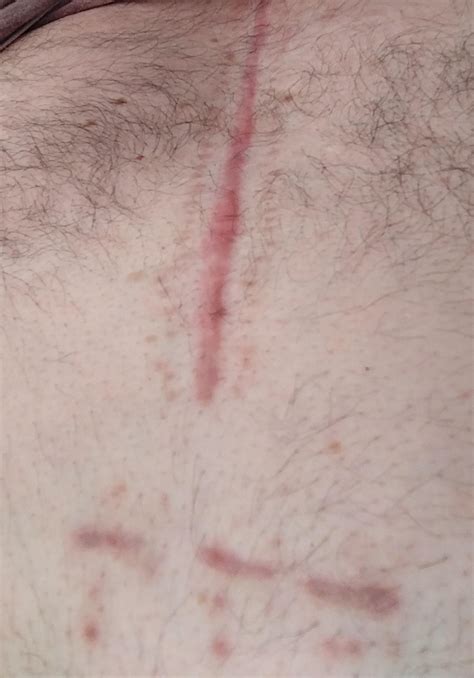 Keloid Scar R Medical