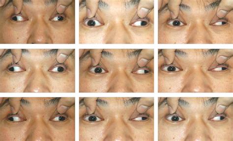 Trochlear Nerve Palsy Eye Position