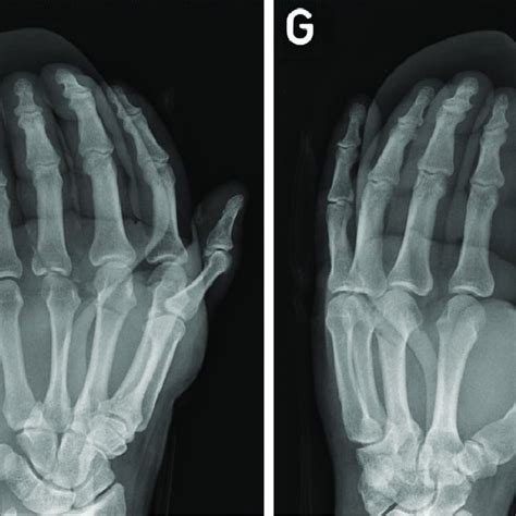 Locked Metacarpophalangeal Joint Secondary To Radial Collateral