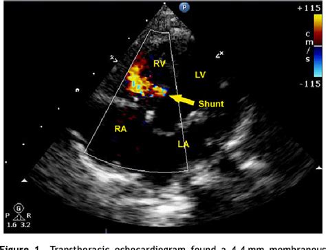 Figure 1 From A Case Of Acute Myocardial Infarction After Successful