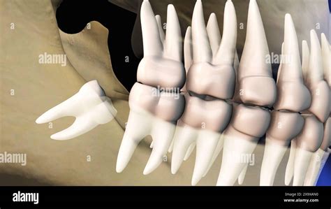 Concept of wisdom teeth pain Stock Photo - Alamy